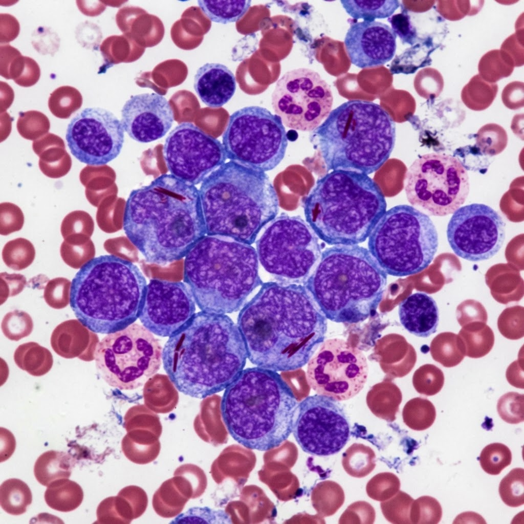 Metabolic Therapies for Hard-to-Treat Cancers